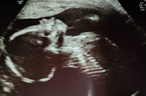 19-weeks-pregnant-after-reversing-tubes