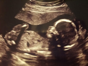 Essure-reversal-and-endometrial-ablation-pregnancy