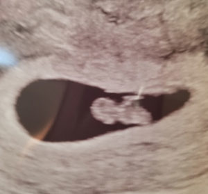 wv-tubal-reversal-baby-from-Martinsburg