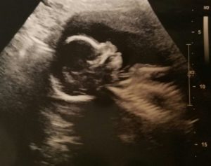 tubal-ligation-reversal-Montana-baby-on-ultrasound