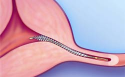 Essure-causes-tubal-blockage-newest-tubal-ligation-procedure