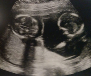 fraternal-twin-girls-Essure-reversal-Georgia