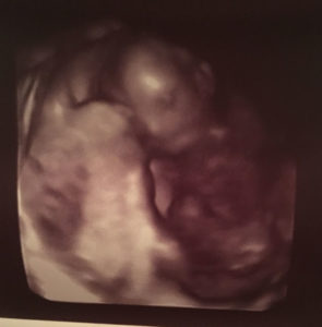 Harriman-TN-tubal-reversal-baby-girl-aftter-reversing-cut-tied-tubes