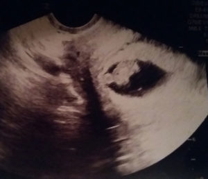 Virginia Essure reversal baby