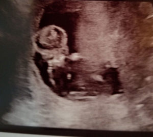 our-reversal-baby-is-our-little-cupcake