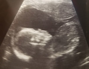 tubal-reversal-works-after-two-failed-ivf-cycles