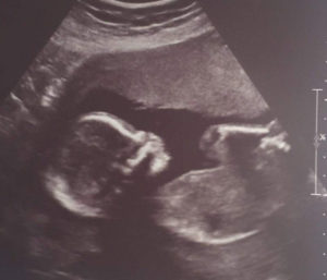 canadian-mom-pregnant-quickly-after-tubal-reversal