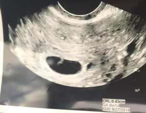 DC-tubal-reversal-baby-on-the-way