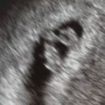7-weeks-pregnant-after-reversing-burned-tubes