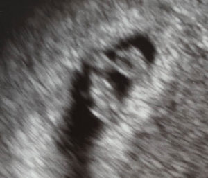 7-weeks-pregnant-after-reversing-burned-tubes