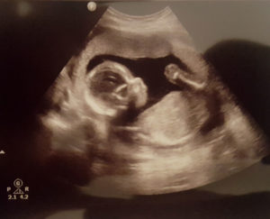 halfway-through-essure-reversal-pregnancy
