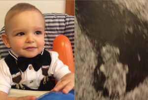 tubal-reversal-siblings-from-europe