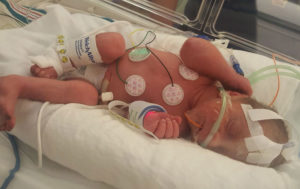 miracle-baby-born-after-endometrial-ablation-and-Essure-reversal