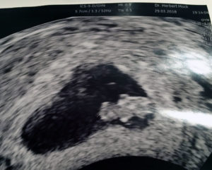 traveling-from-europe-for-tubal-reversa-with-dr-monteith