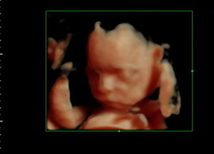 essure-reversal-surgery-worked-having-a-boy