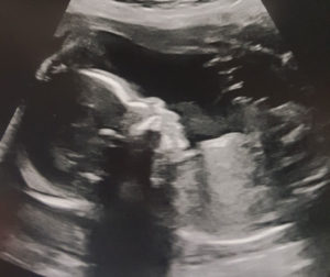 vasectomy-reversal-with-dr-monteith