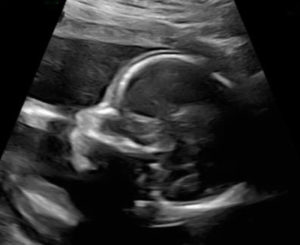 21-weeks-pregnant-5-months-after-tubal-reversal