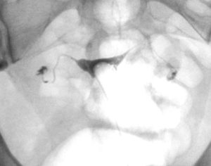 hsg-showed-both-tubes-open