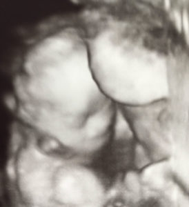 22-weeks-pregnant-after-reversing-tied-and-cut-tubes