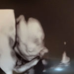 Essure-reversal-baby-at-21-weeks-gestation