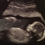 Elkins-WV-tubal-reversal-baby-20-week-ultrasound