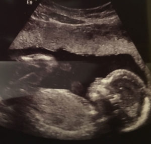 Elkins-WV-tubal-reversal-baby-20-week-ultrasound