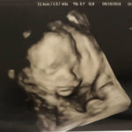 22-week-ultrasound-of-baby-conceived-after-tubal-reversal