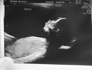 tubal-reversal-surgery-provided-quick-amazing-blessing