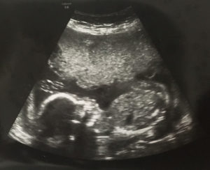 reversing-burned-tubal-ligation