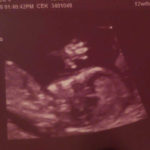 baby-waves-at-world-during-prenatal-ultrasound