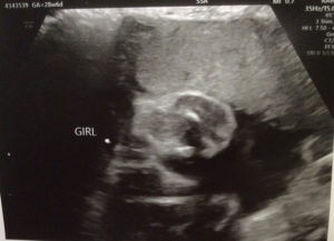 Cirugía de reversión de la ligadura de trompas con el Dr Monteith