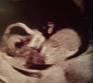 12-weeks-pregnant-after-tubal-reversal