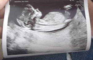 pregnant-after-ring-tubal-reversal