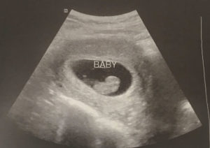 pregnant-again-after-tubal-reversal-singleton-not-twins