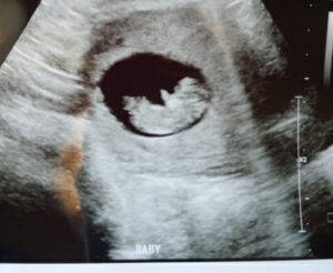 tubal-clip-reversal-baby-number-2-one-the-way