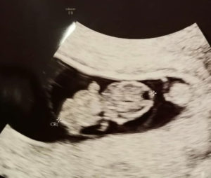 happy-with-dr-monteith-and-tubal-reversal-of-clips