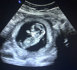 south-dakotan-tubal-reversal-baby-in-the-oven