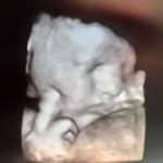 tubal-reversal-baby-due-in-4-weeks