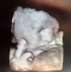 tubal-reversal-baby-due-in-4-weeks