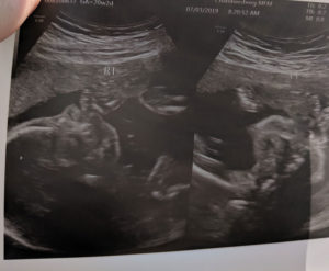 gender-reveal-after-reversing-tubal-clips