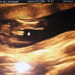 17-weeks-pregnant-after-removing-tubal-clips-dr-monteith