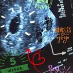 longest-wait-after-tubal-reversal-baby-in-uterus