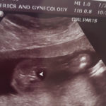 oklahoma-tubal-reversal-20-weeks-pregnant