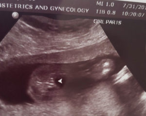 oklahoma-tubal-reversal-20-weeks-pregnant