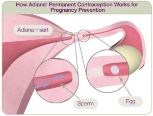 best-procedure-to-reverse-adiana-tubal-ligation