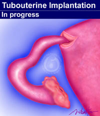 tubouterine-implantation-is-best-procedure-to-reverse-adiana-tubal-ligation