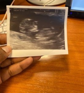 reversing-cut-tied-tubes-nj-tubal-reversal-patient