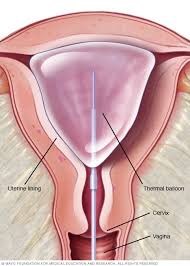 pregnancy-is-possible-after-endometrial-thermachoice-balloon-ablation