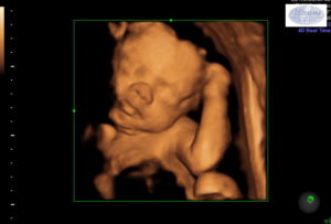 essure-reversal-surgery-with-dr-monteith-35-weeks-pregnant