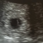 Clarksville-TN-Essure-reversal-intrauterine-pregnancy